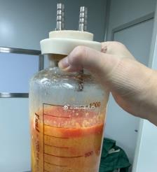 玉树水动力吸脂手术要做多久？